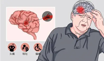 Evaluation of the Safety and Efficacy of Neurotrophic factor therapy in Ischemic Stroke