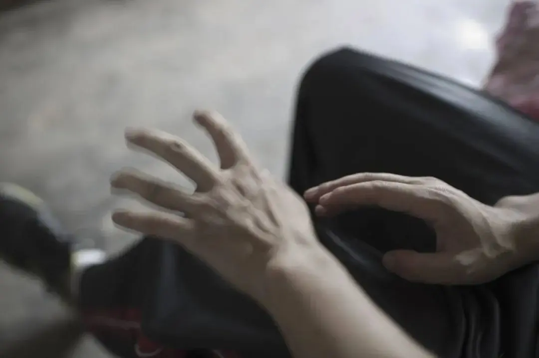 A new method of treating Parkinson's disease is Ruimi DBS robotic surgery