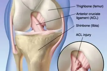 Advanced Knee Recovery Solutions