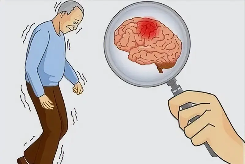 Cerebral Apoplexya2p