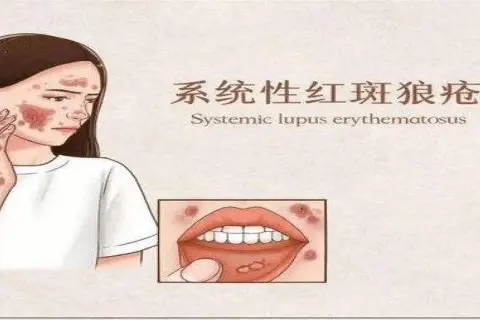 Comprehensive Lupus Management