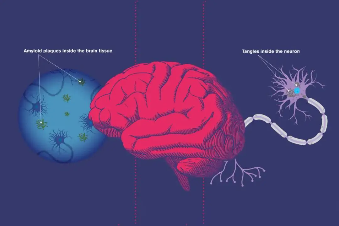 Holistic Alzheimer's Care Approach